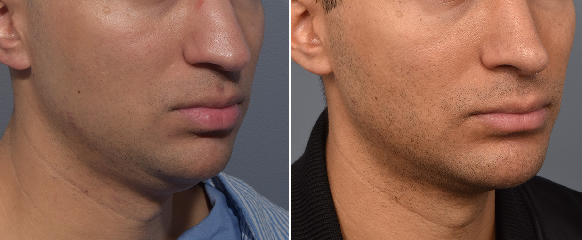Chin Implant Before & After Gallery - Patient 726509 - Image 4