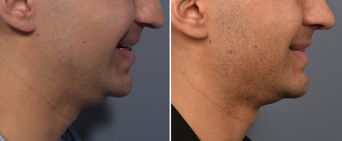 Chin Implant Before & After Gallery - Patient 726509 - Image 5