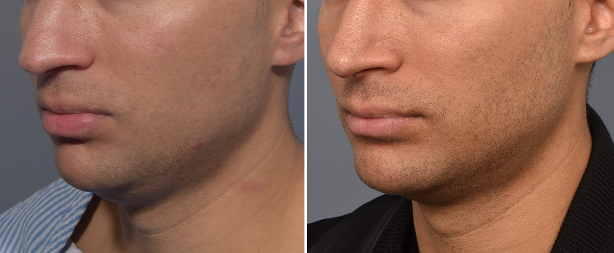 Chin Implant Before & After Gallery - Patient 726509 - Image 1