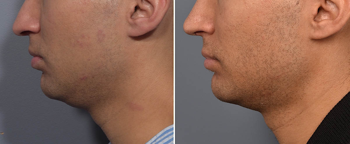 Chin Implant Before & After Gallery - Patient 726509 - Image 2