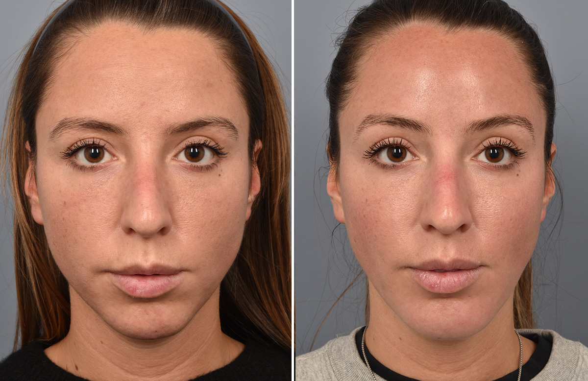 Chin Implant Before & After Gallery - Patient 128001 - Image 8