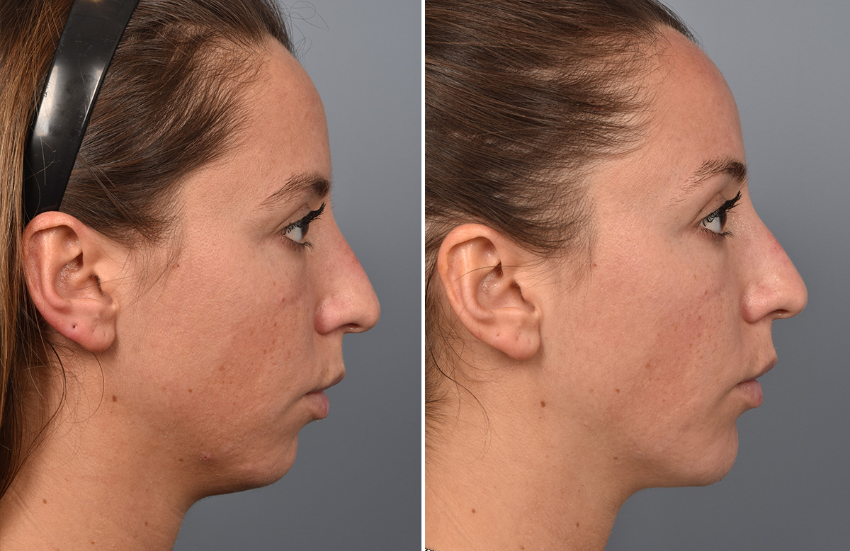 Chin Implant Before & After Gallery - Patient 128001 - Image 10