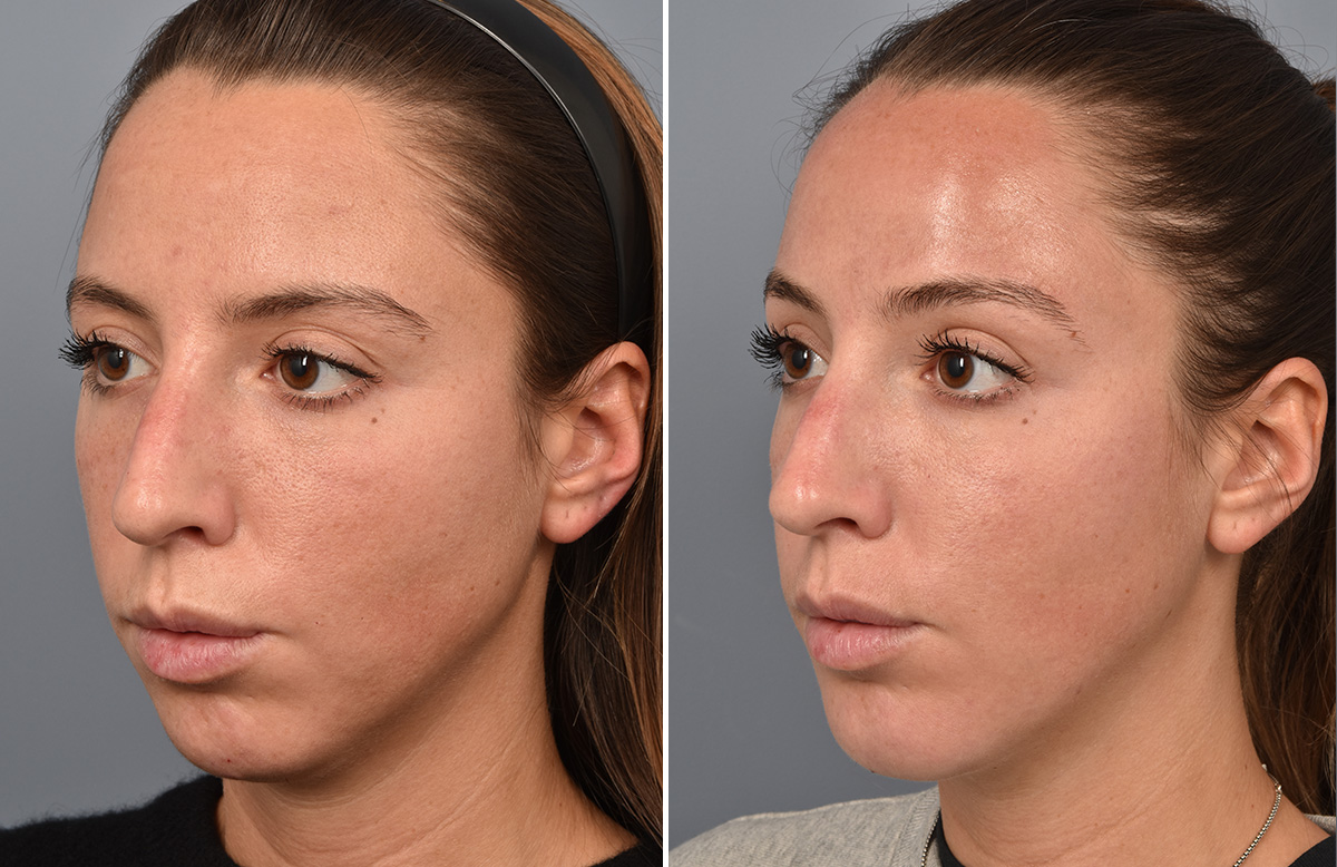 Chin Implant Before & After Gallery - Patient 128001 - Image 6
