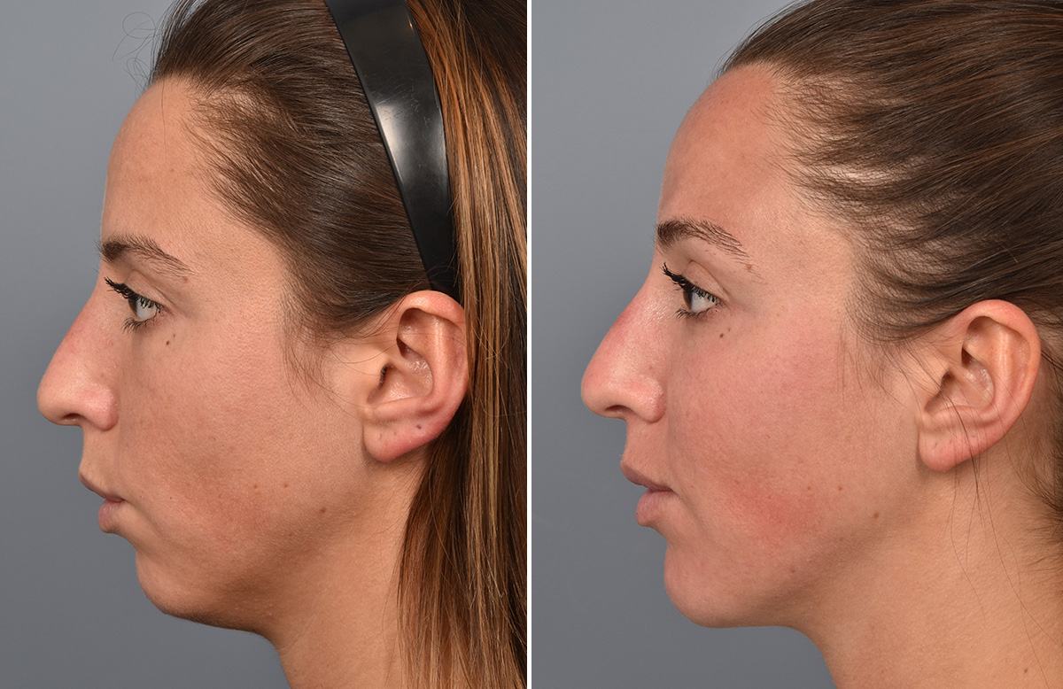 Chin Implant Before & After Gallery - Patient 128001 - Image 7