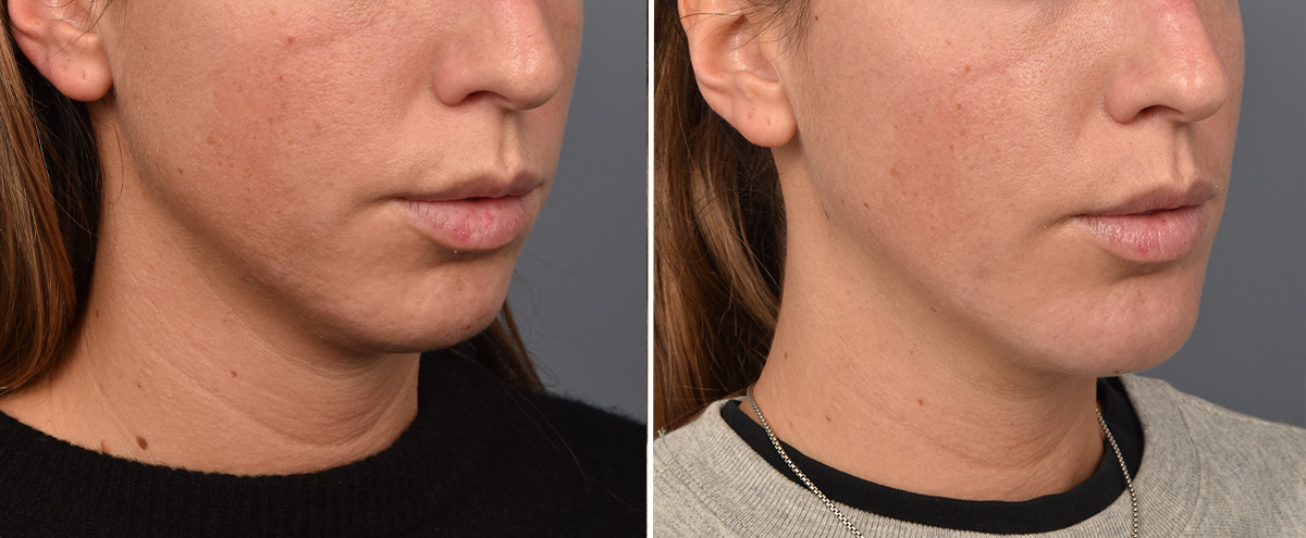 Chin Implant Before & After Gallery - Patient 128001 - Image 4
