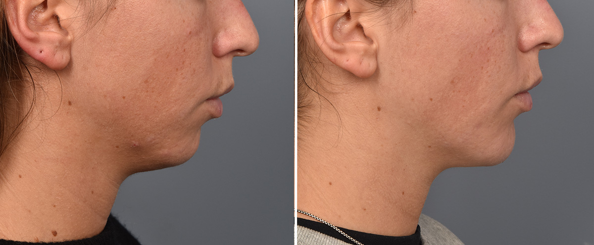 Chin Implant Before & After Gallery - Patient 128001 - Image 5