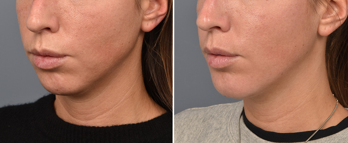 Chin Implant Before & After Gallery - Patient 128001 - Image 1