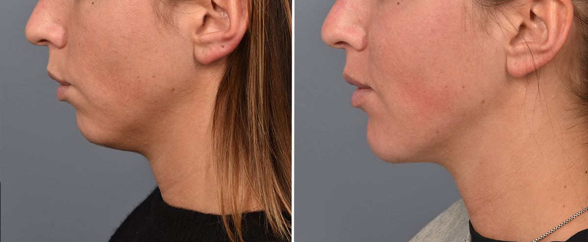 Chin Implant Before & After Gallery - Patient 128001 - Image 2
