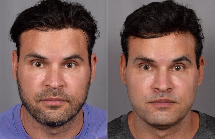 Buccal Fat Removal Before & After Gallery - Patient 192164 - Image 1