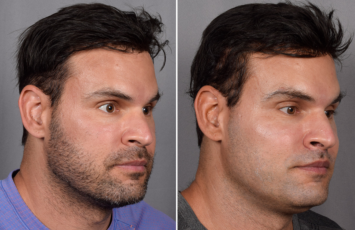 Lip Lift Before & After Gallery - Patient 330047 - Image 11
