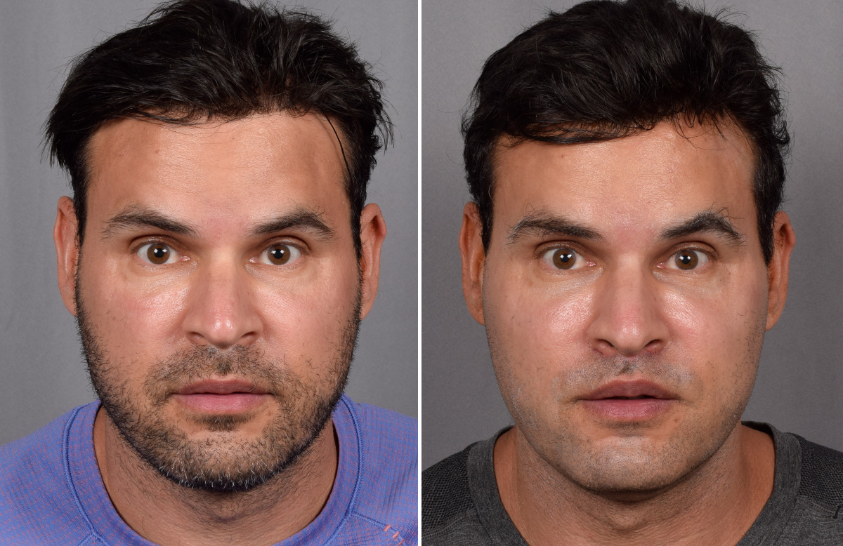 Lip Lift Before & After Gallery - Patient 330047 - Image 9