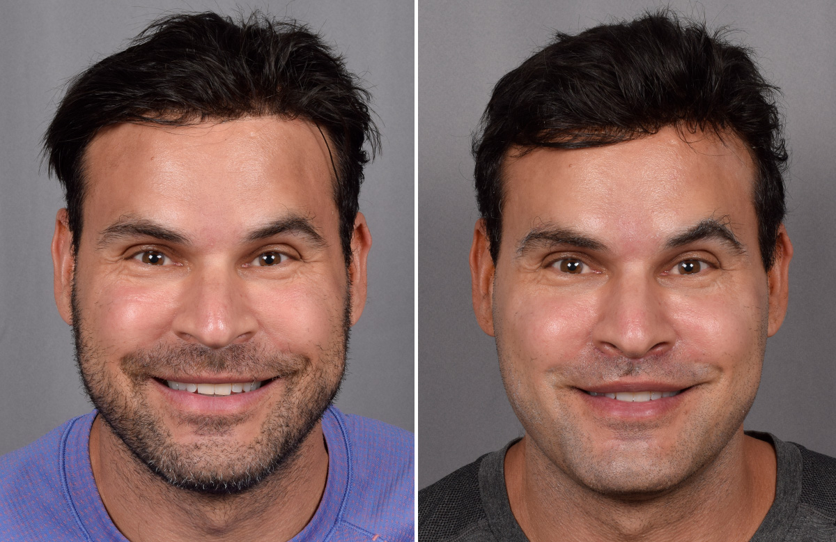 Lip Lift Before & After Gallery - Patient 330047 - Image 10