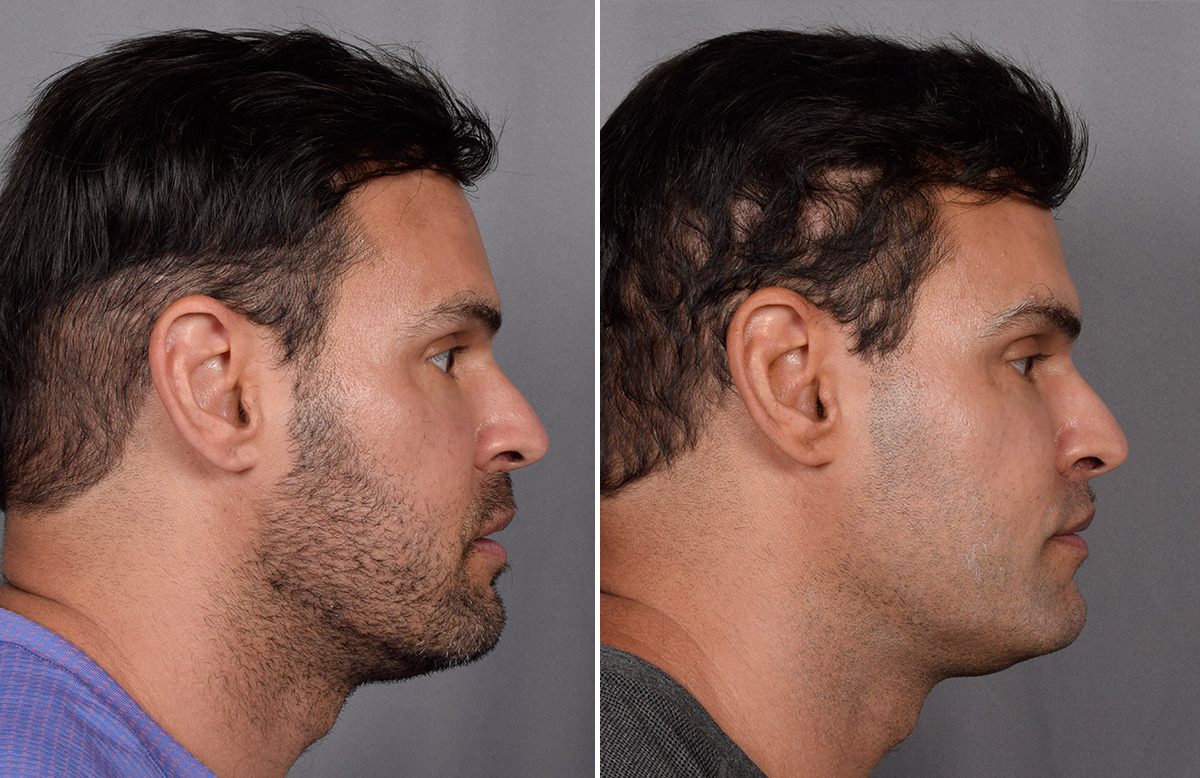 Lip Lift Before & After Gallery - Patient 330047 - Image 12