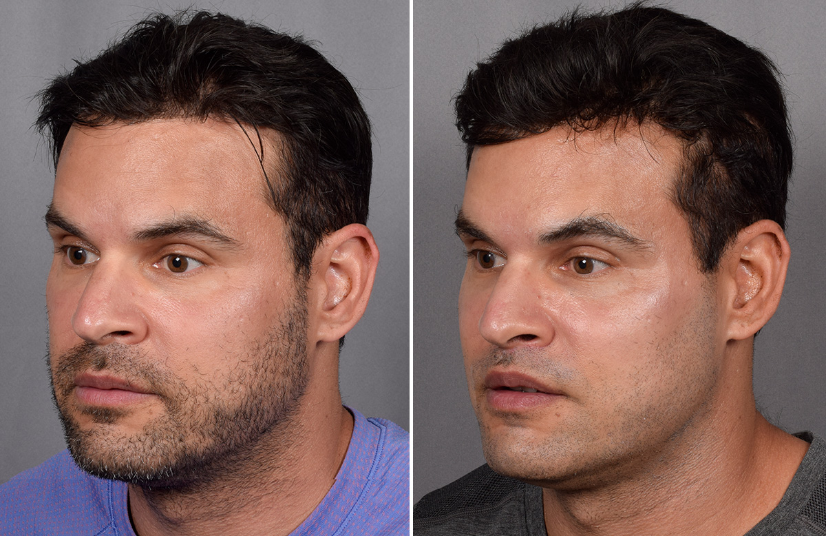 Lip Lift Before & After Gallery - Patient 330047 - Image 13