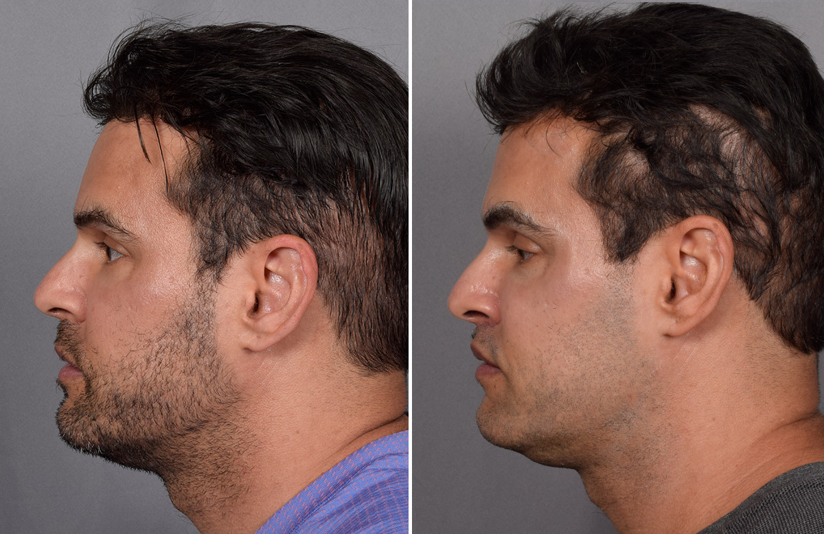 Lip Lift Before & After Gallery - Patient 330047 - Image 14