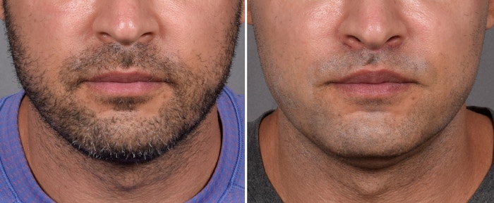 Lip Lift Before & After Gallery - Patient 330047 - Image 1