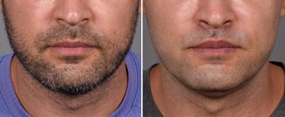 Lip Lift Before & After Gallery - Patient 330047 - Image 1