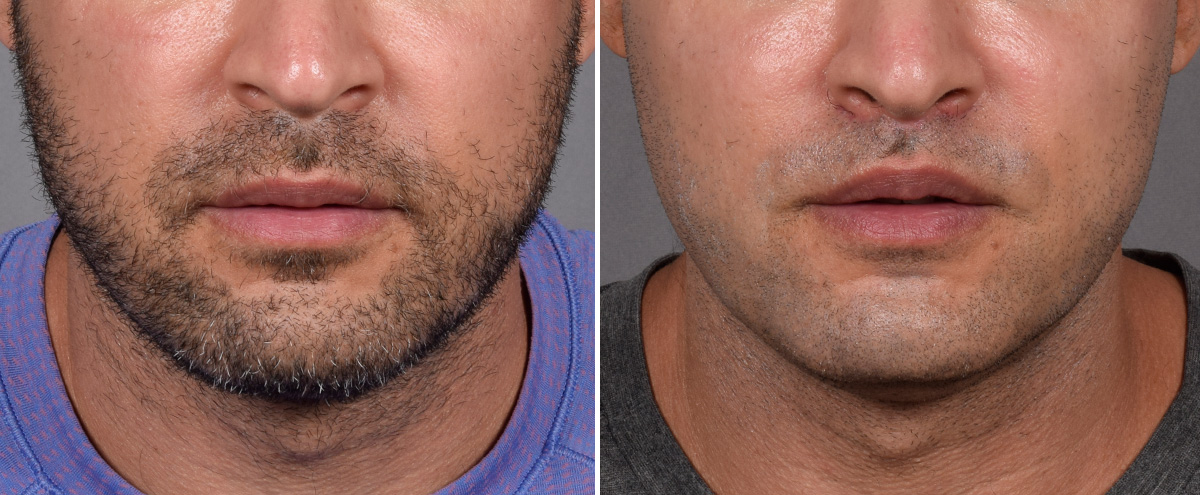 Lip Lift Before & After Gallery - Patient 330047 - Image 2