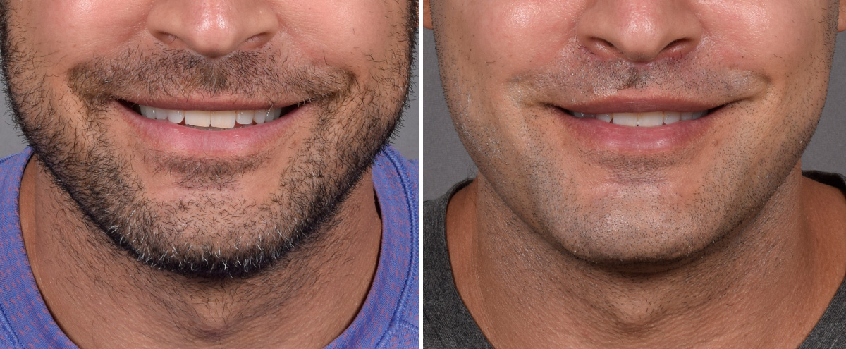Lip Lift Before & After Gallery - Patient 330047 - Image 3
