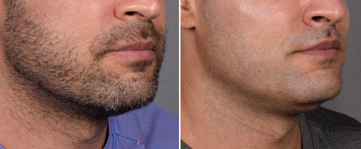 Lip Lift Before & After Gallery - Patient 330047 - Image 5