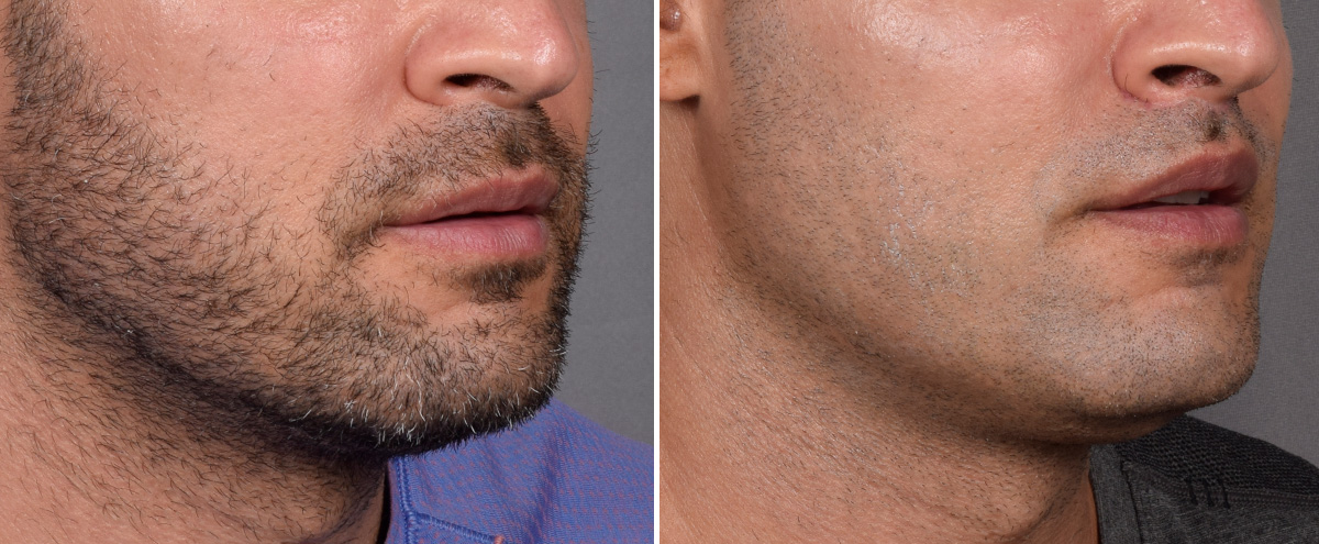 Lip Lift Before & After Gallery - Patient 330047 - Image 4