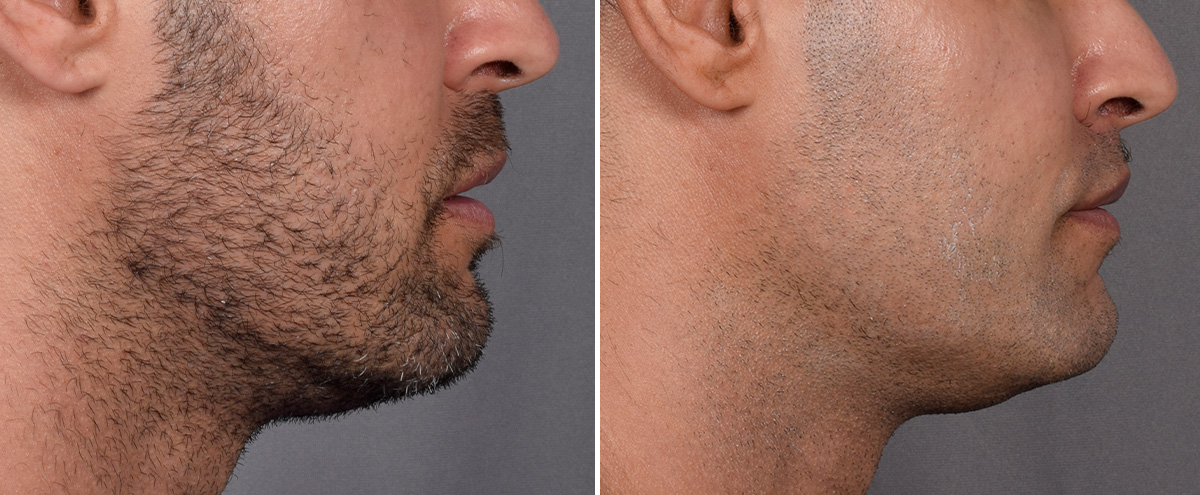 Lip Lift Before & After Gallery - Patient 330047 - Image 6