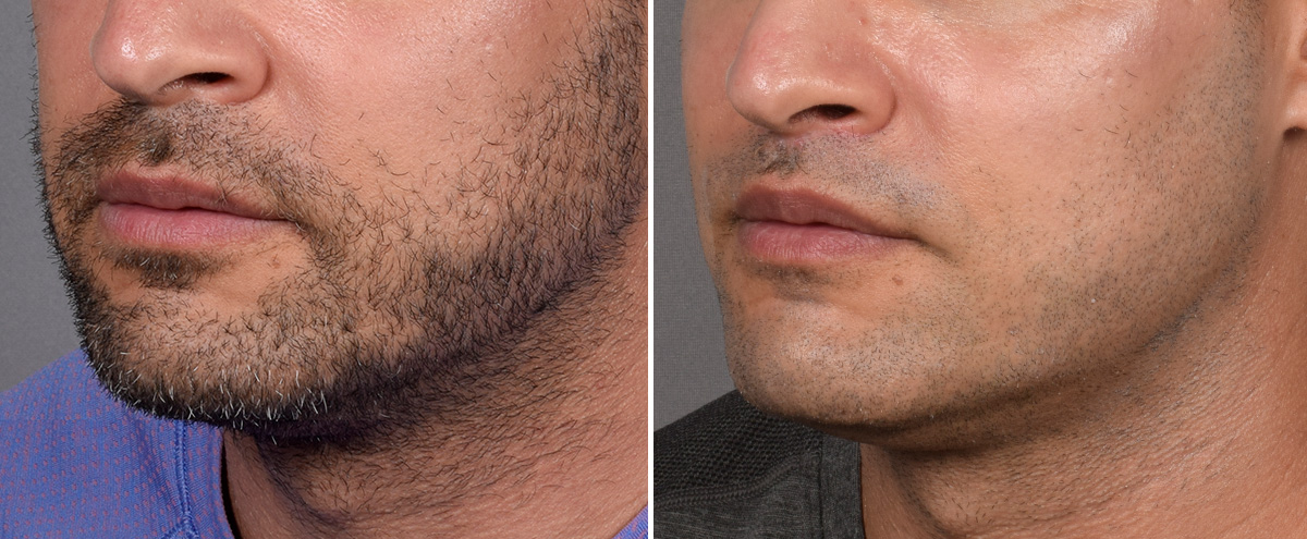 Lip Lift Before & After Gallery - Patient 330047 - Image 7