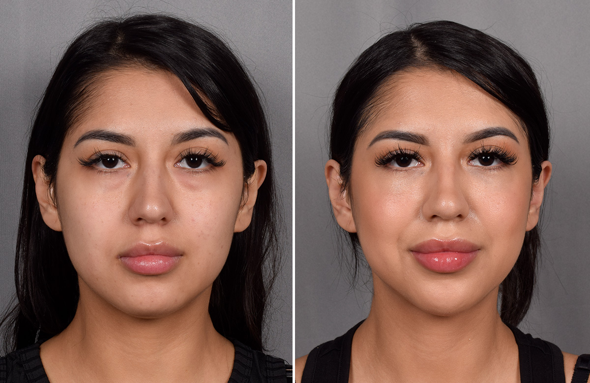 CO2 Laser Before & After Gallery - Patient 318014 - Image 3
