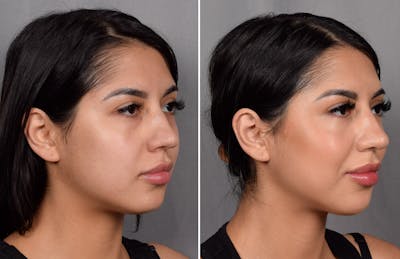 CO2 Laser Before & After Gallery - Patient 318014 - Image 1