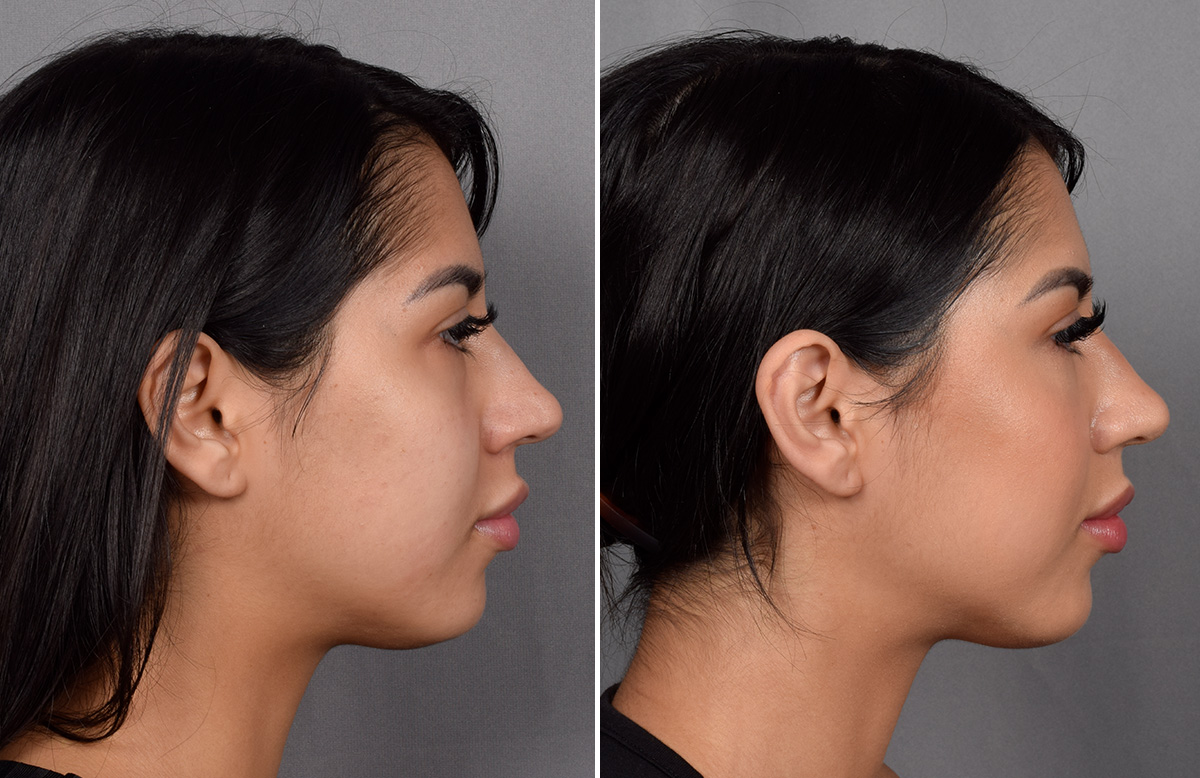 CO2 Laser Before & After Gallery - Patient 318014 - Image 2