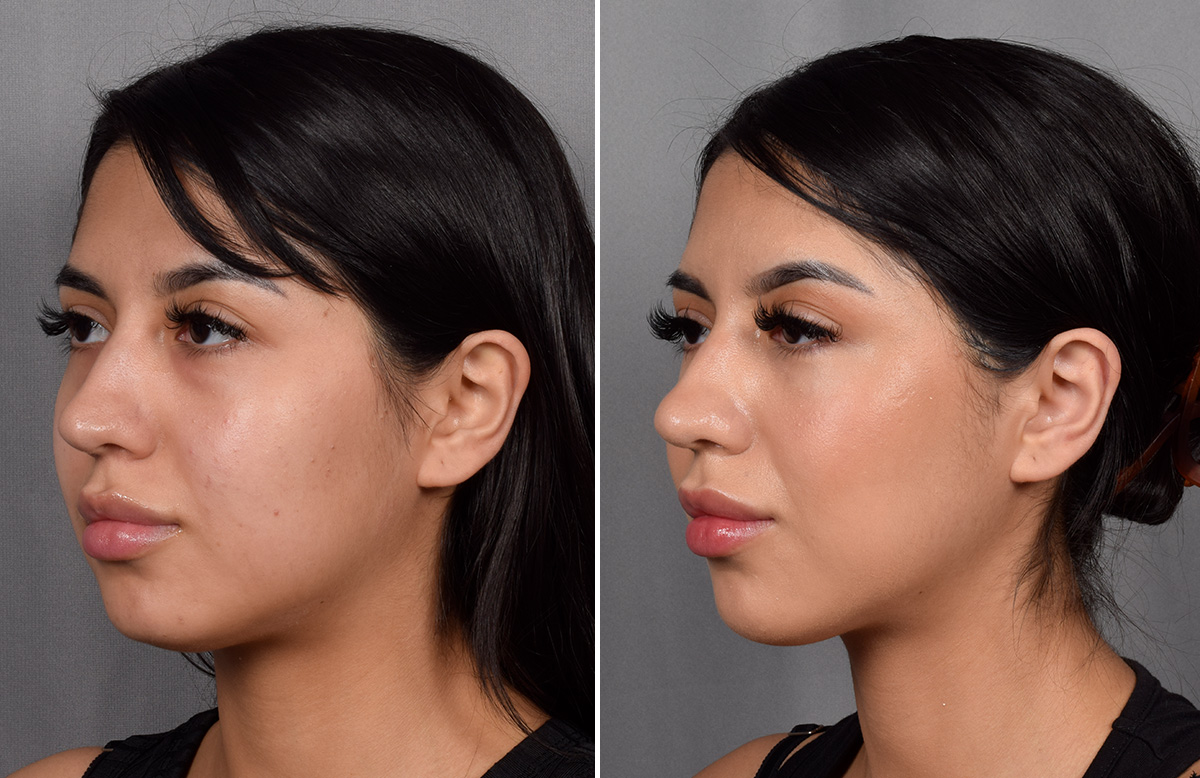 CO2 Laser Before & After Gallery - Patient 318014 - Image 4