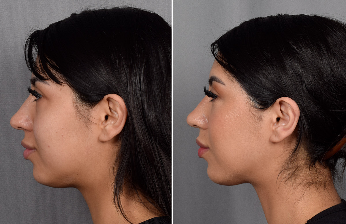 CO2 Laser Before & After Gallery - Patient 318014 - Image 5