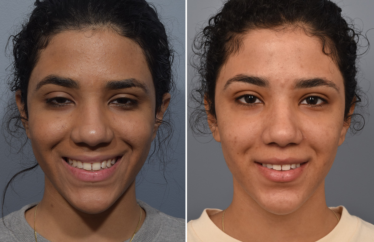 Lip Lift Before & After Gallery - Patient 381784 - Image 6