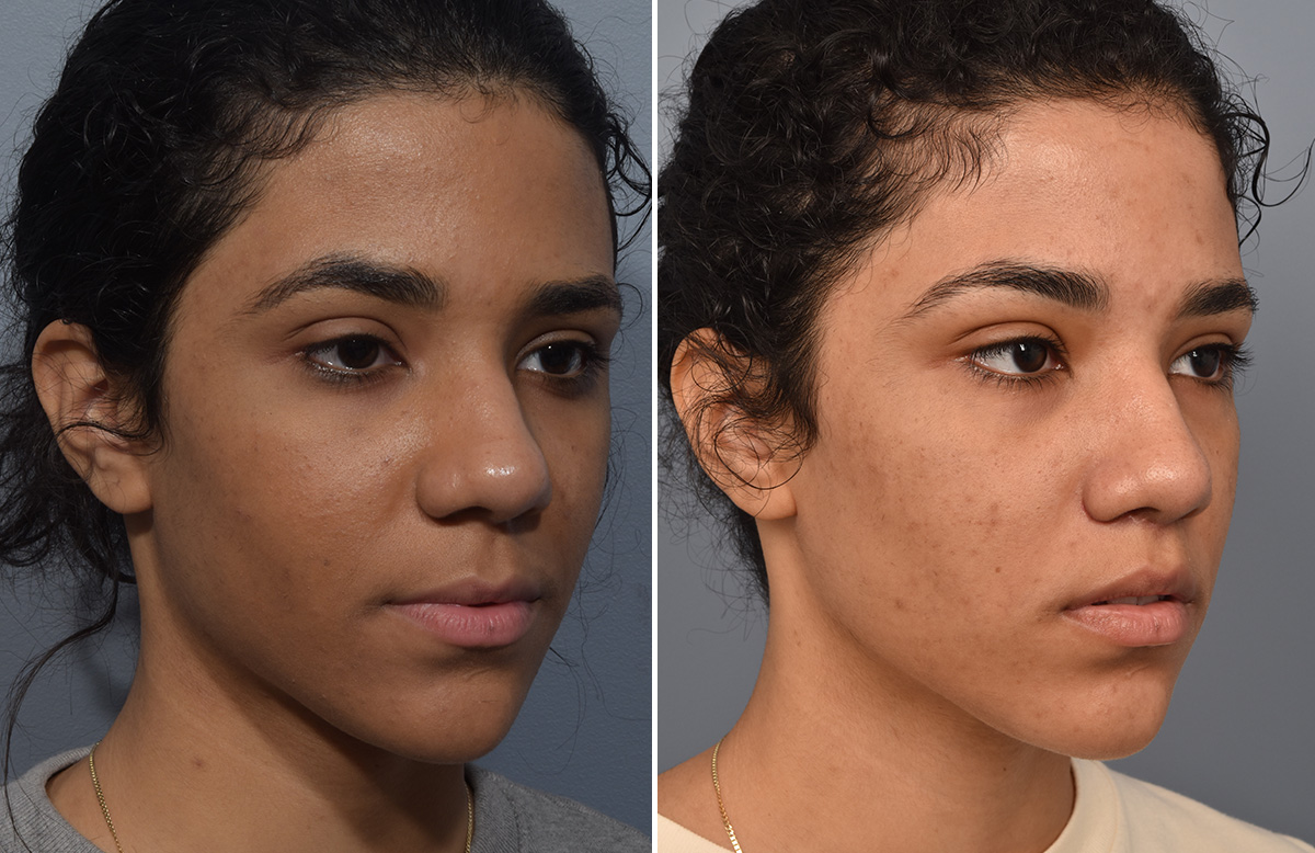 Lip Lift Before & After Gallery - Patient 381784 - Image 7