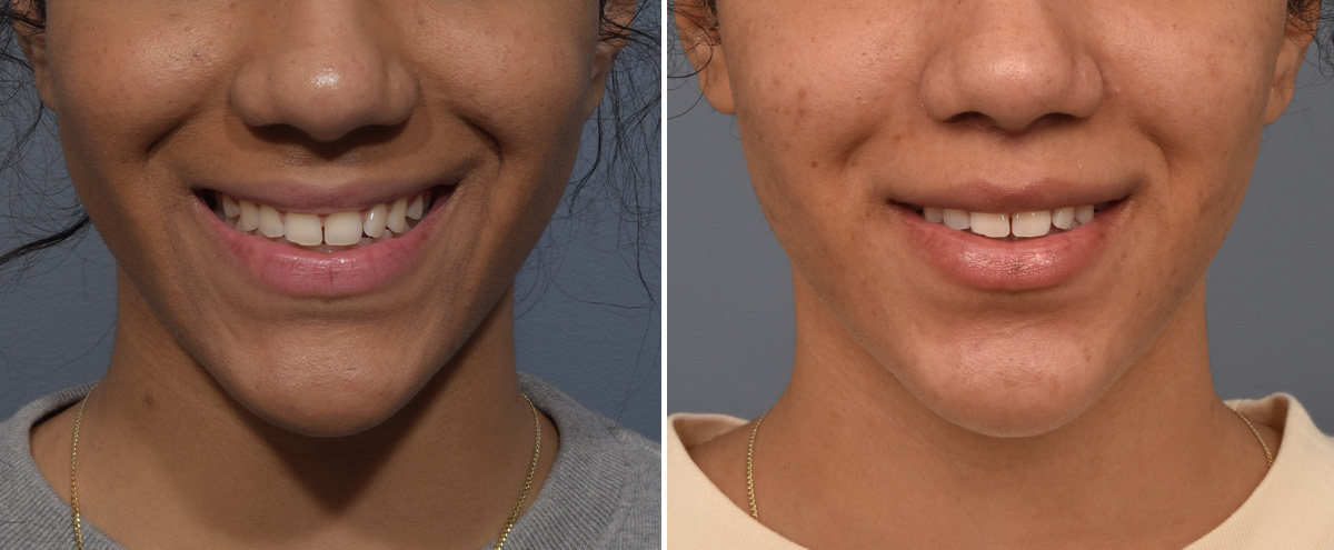 Lip Lift Before & After Gallery - Patient 381784 - Image 2