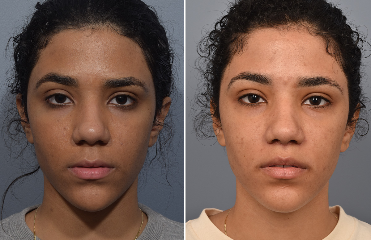 Lip Lift Before & After Gallery - Patient 381784 - Image 5