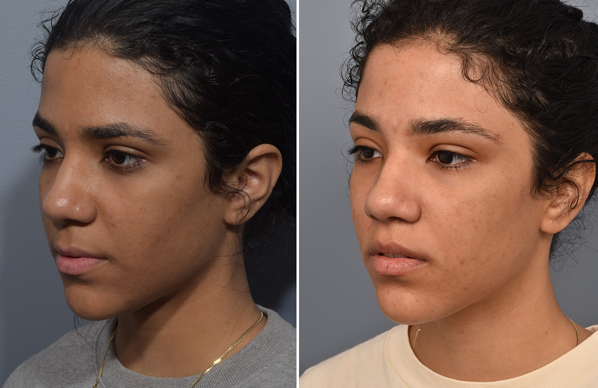 Lip Lift Before & After Gallery - Patient 381784 - Image 8