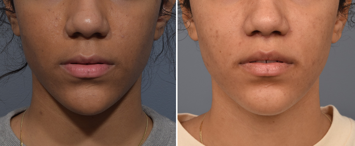 Lip Lift Before & After Gallery - Patient 381784 - Image 1