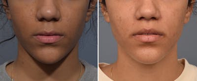 Lip Lift Before & After Gallery - Patient 381784 - Image 1