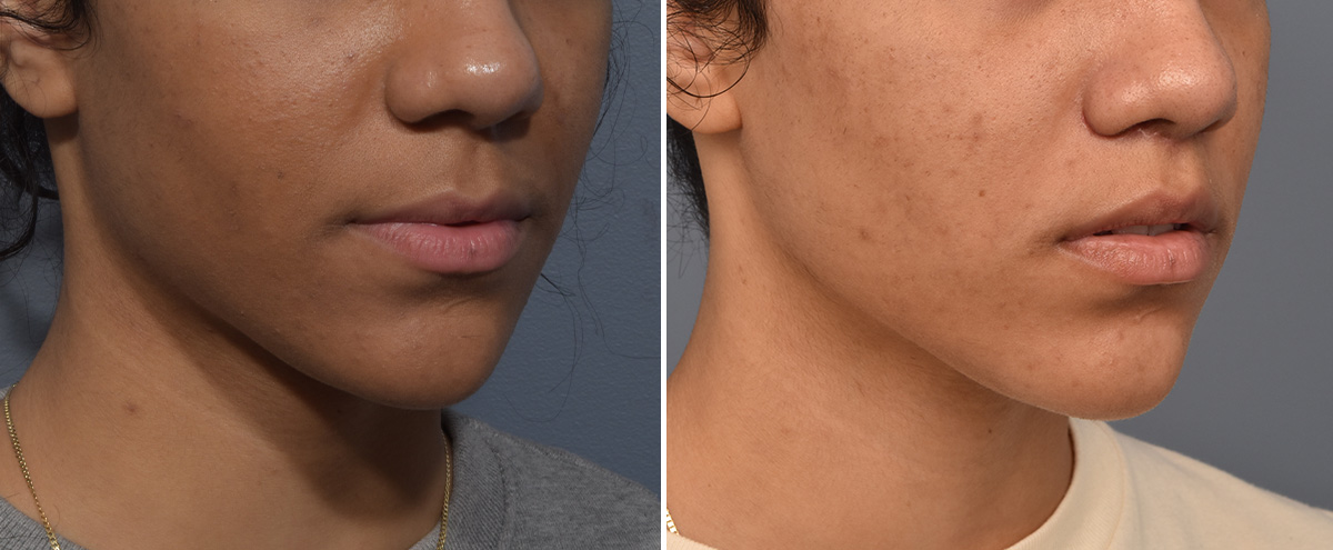 Lip Lift Before & After Gallery - Patient 381784 - Image 3