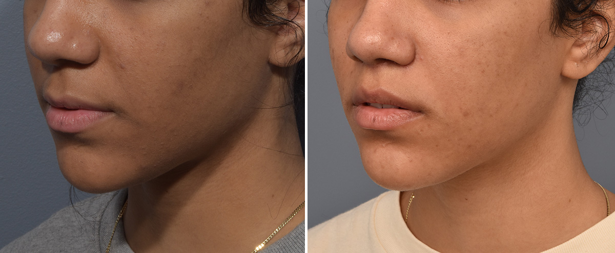 Lip Lift Before & After Gallery - Patient 381784 - Image 4