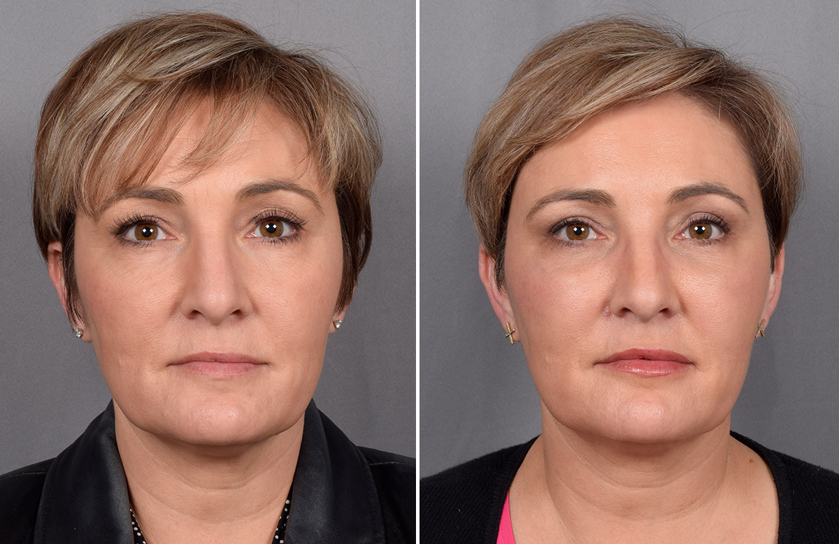 CO2 Laser Before & After Gallery - Patient 166740 - Image 3