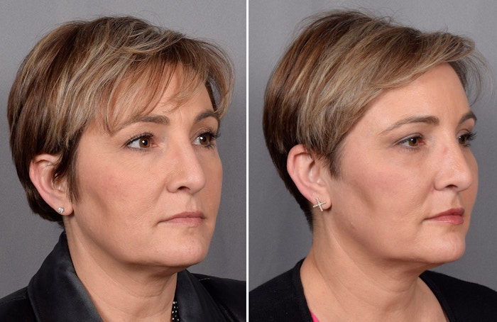 CO2 Laser Before & After Gallery - Patient 166740 - Image 1