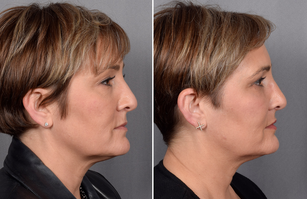 CO2 Laser Before & After Gallery - Patient 166740 - Image 2