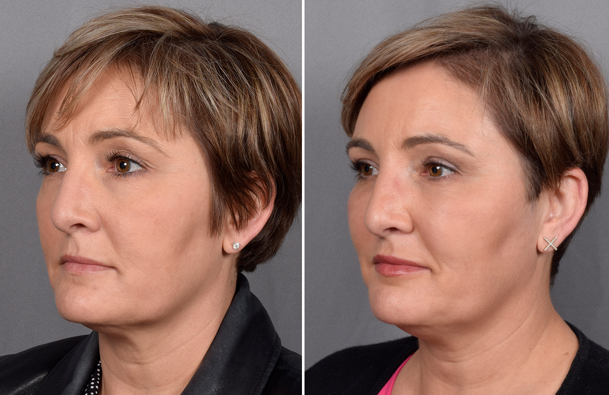 CO2 Laser Before & After Gallery - Patient 166740 - Image 4