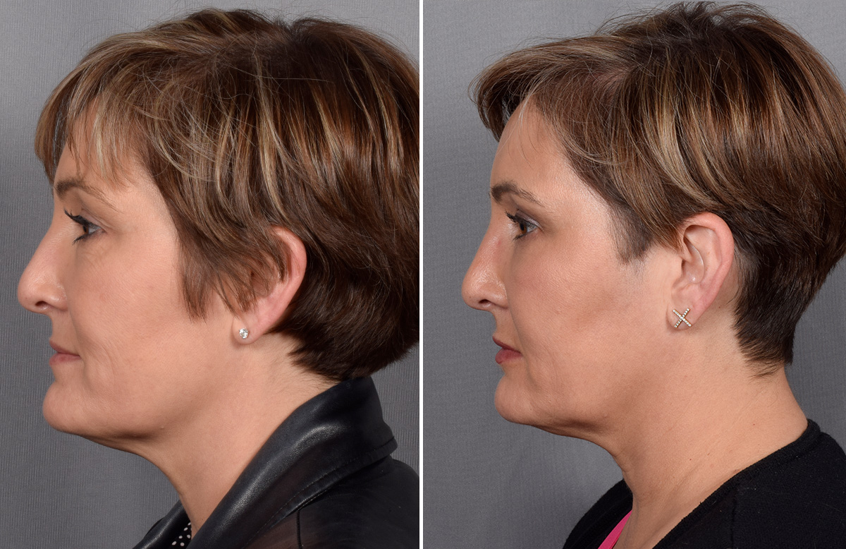 CO2 Laser Before & After Gallery - Patient 166740 - Image 5