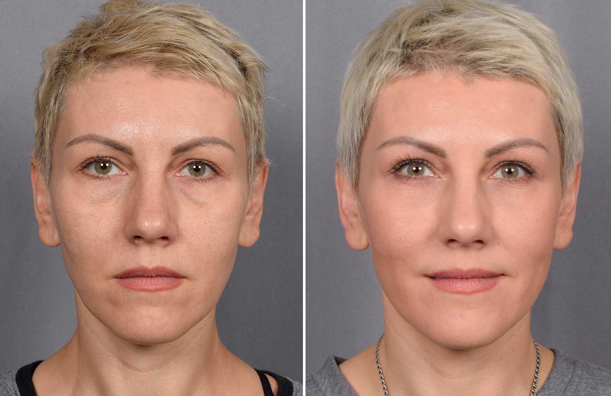 CO2 Laser Before & After Gallery - Patient 637576 - Image 3