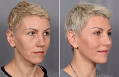 CO2 Laser Before & After Gallery - Patient 637576 - Image 1