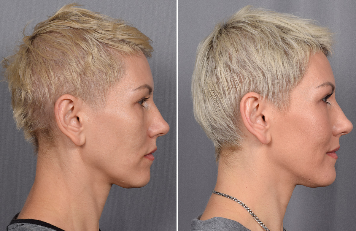 CO2 Laser Before & After Gallery - Patient 637576 - Image 2