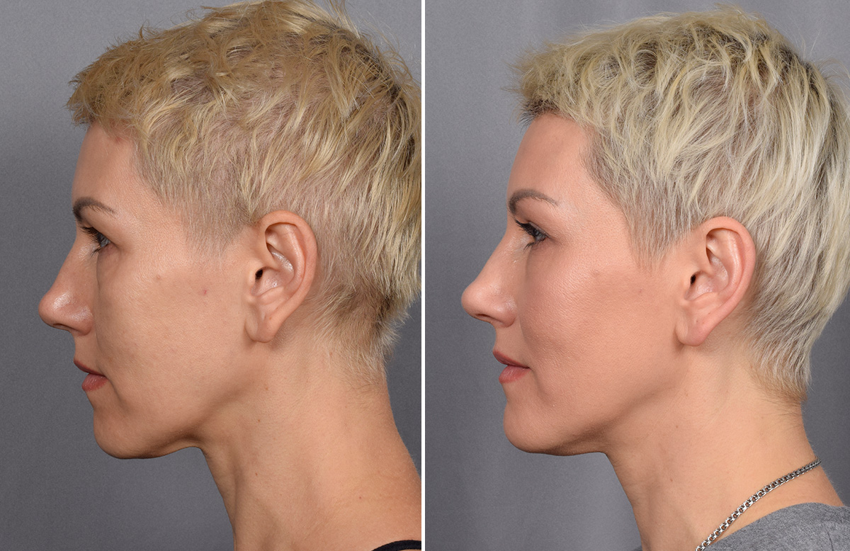 CO2 Laser Before & After Gallery - Patient 637576 - Image 5